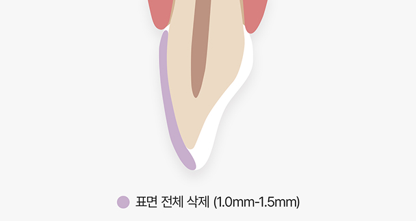 일반 라미네이트