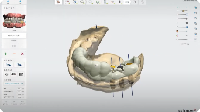 오차율을 낮추는 컴퓨터 분석 임플란트