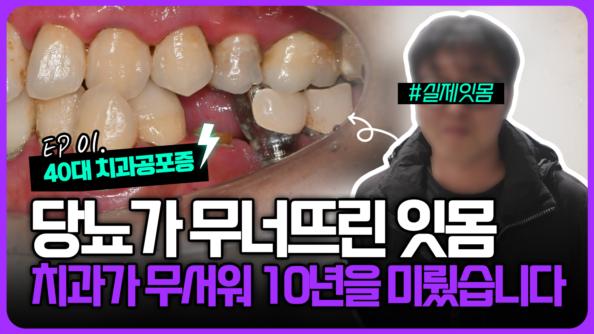 치과가 무서워 10년 동안 미뤄온 임플란트 수술 그 결과는?